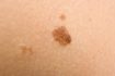 Birthmark sur la peau