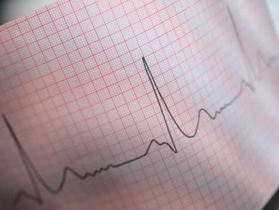 Calcul de la fréquence cardiaque d'un électrocardiogramme